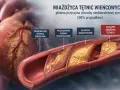 Przedstawienie rozwoju miażdżycy tętnic wieńcowych, od prawidłowej tętnicy do znacznego zwężenia, ilustrujące chorobę wieńcową.