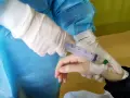 Rękawiczki medyczne przygotowują zastrzyk tocilizumabu.