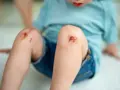 Dziecko z otartymi kolanami. Wczesne objawy tężca mogą być trudne do zauważenia, ale skaleczenia wymagają uwagi.