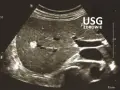 Obraz USG jamy brzusznej z widocznym jasnym ogniskiem. Czy usg jamy brzusznej wykryje raka? To badanie pomaga ocenić narządy wewnętrzne.