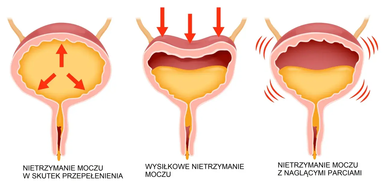 Ilustracja pokazuje trzy rodzaje popuszczania moczu: przepełnienie pęcherza, wysiłkowe i nagłe parcia.