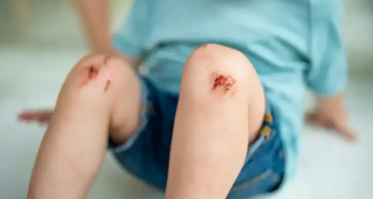 Dziecko z otartymi kolanami po upadku. Ważne jest, by pamiętać o szczepionce na tężec, która chroni przed groźnymi infekcjami.