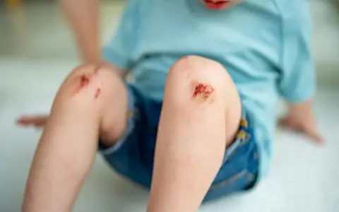 Dziecko z otartymi kolanami. Wczesne objawy tężca mogą być trudne do zauważenia, ale skaleczenia wymagają uwagi.