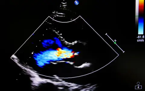 Obraz USG serca z kolorowym Dopplerem, pokazujący przepływ krwi. Może być pomocny w diagnostyce przewlekłej niewydolności żylnej.