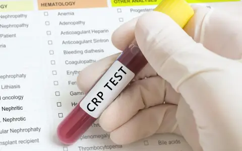 Ręka w rękawiczce trzyma probówkę z napisem "CRP TEST". Obok formularz z listą badań, m.in. hematologicznych.