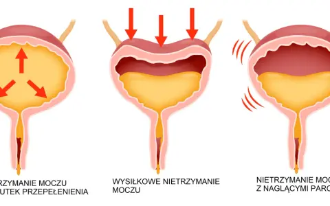 Ilustracja pokazuje trzy rodzaje popuszczania moczu: przepełnienie pęcherza, wysiłkowe i nagłe parcia.