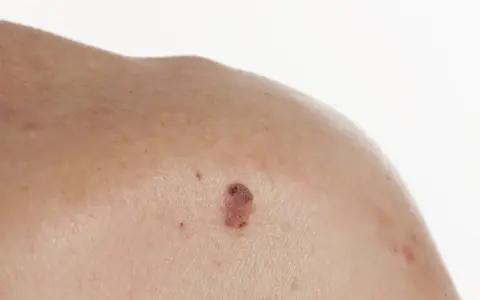 Zmiana skórna na ramieniu, przypominająca raka kolczystokomórkowego.