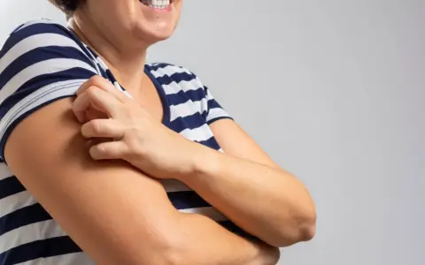 Kobieta w pasiastym T-shircie drapie się po ramieniu, doświadczając bardzo nietypowe objawy menopauzy, takie jak swędzenie skóry.