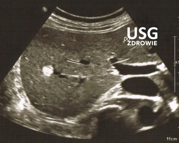 Obraz USG jamy brzusznej z widocznym jasnym ogniskiem. Czy usg jamy brzusznej wykryje raka? To badanie pomaga ocenić narządy wewnętrzne.