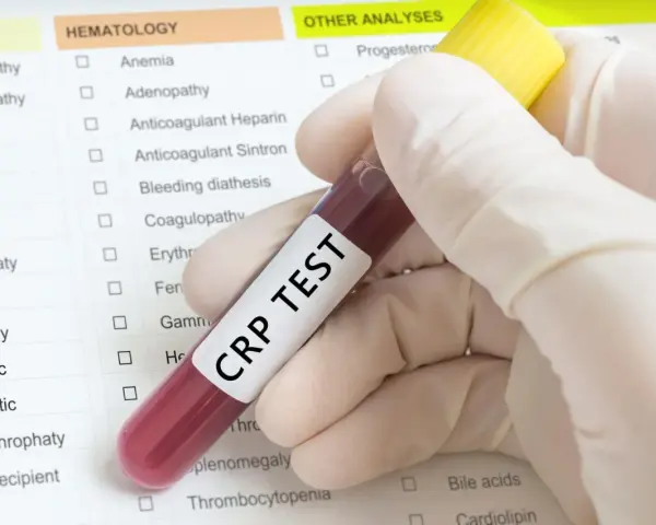 Ręka w rękawiczce trzyma probówkę z napisem "CRP TEST". Obok formularz z listą badań, m.in. hematologicznych.