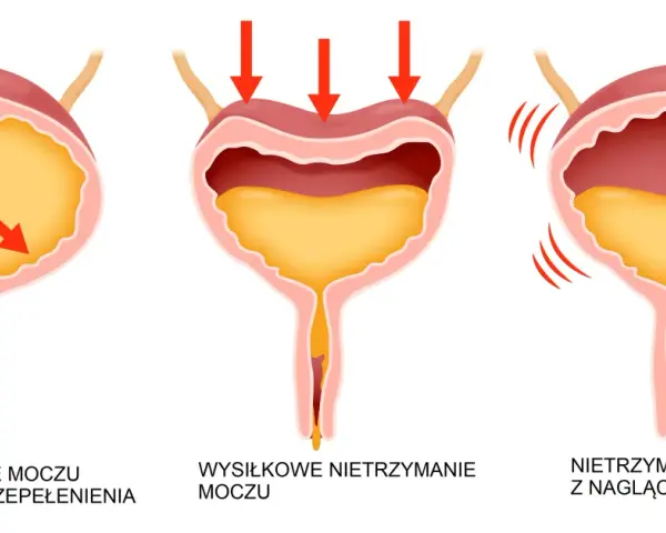 Ilustracja pokazuje trzy rodzaje popuszczania moczu: przepełnienie pęcherza, wysiłkowe i nagłe parcia.