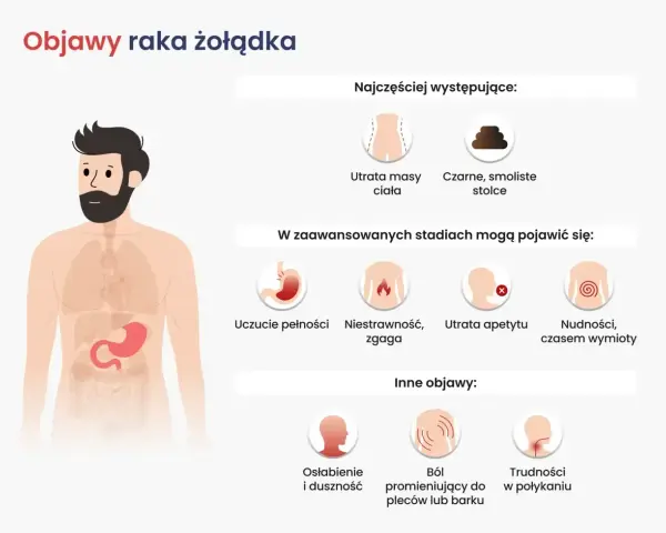 Ilustracja przedstawia objawy raka żołądka: utratę masy ciała, czarne stolce, uczucie pełności, niestrawność, zgagę, utratę apetytu, nudności, wymioty, osłabienie, ból pleców i trudności w połykaniu.