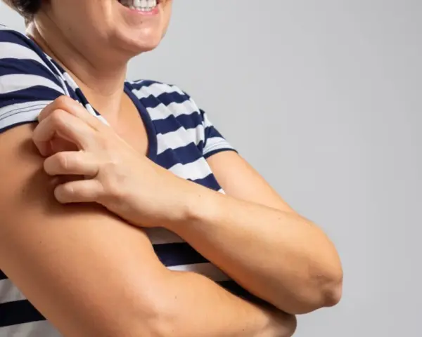Kobieta w pasiastym T-shircie drapie się po ramieniu, doświadczając bardzo nietypowe objawy menopauzy, takie jak swędzenie skóry.