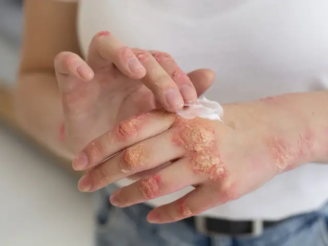 Dłoń z łuszczycą, na którą nakładany jest krem.