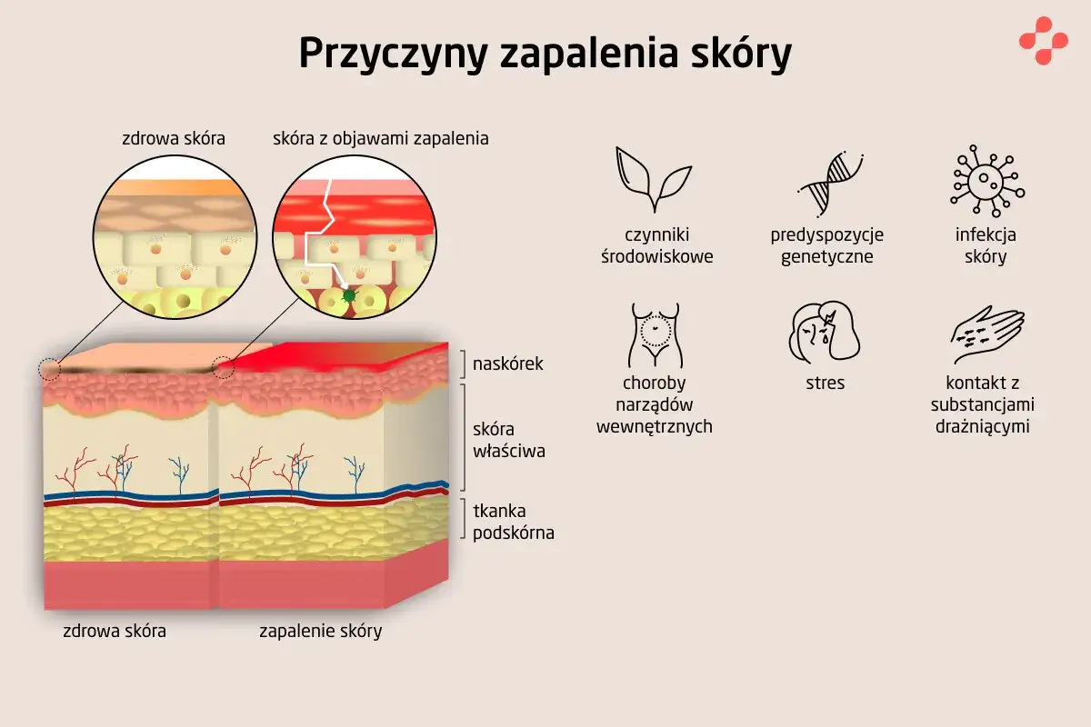 Ilustracja przedstawia atopowe zapalenie skóry przyczyny: czynniki środowiskowe, genetyczne, infekcje, choroby wewnętrzne, stres i kontakt z substancjami drażniącymi.