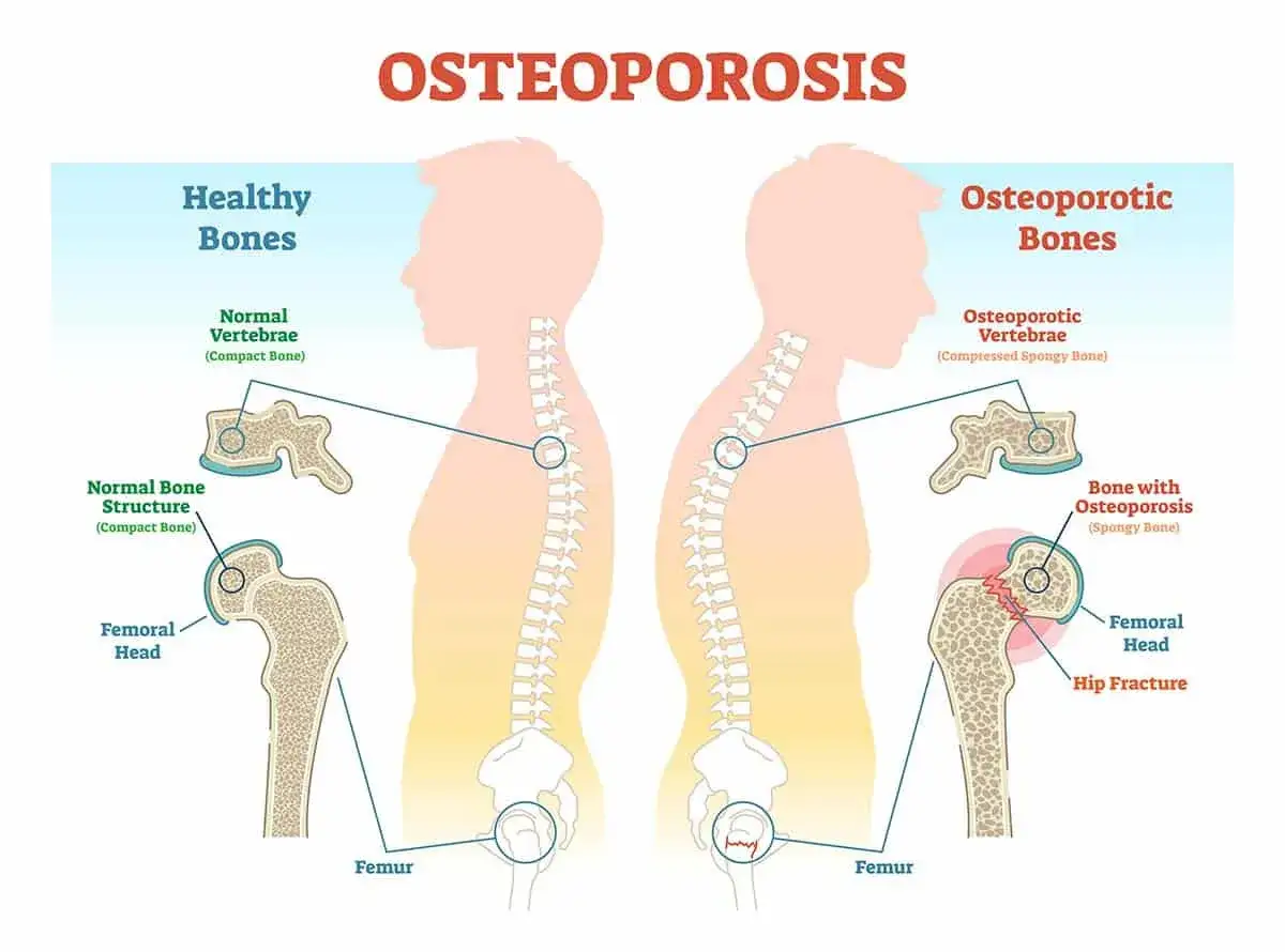 Porównanie zdrowych kości z kośćmi dotkniętymi osteoporozą. Pokazuje różnice w strukturze kręgów i szyjki kości udowej, uwidaczniając ryzyko złamań.